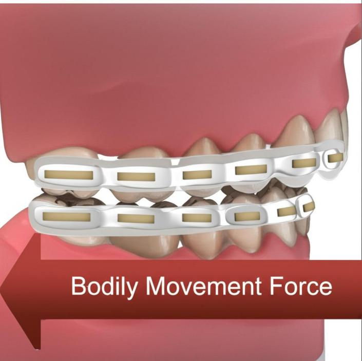 Long horizontal buccal attachment with three-sided aligner channel